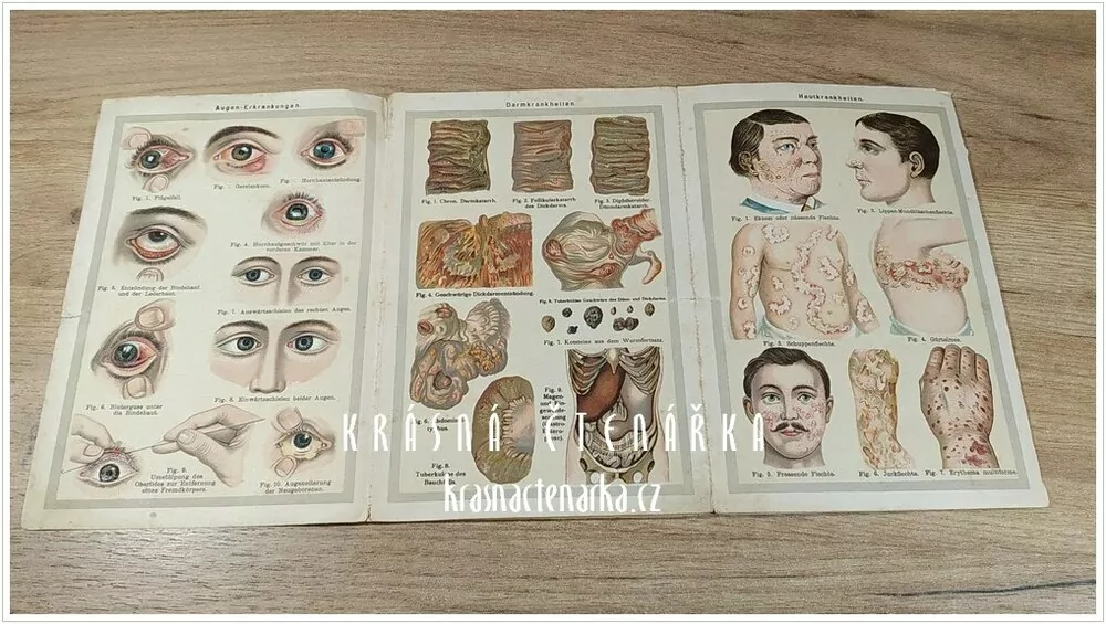 ATLAS ÄUßERER UND INNERER KRANKHEITEN des menschlichen Körpers zu Bilz, Naturheilvefahren