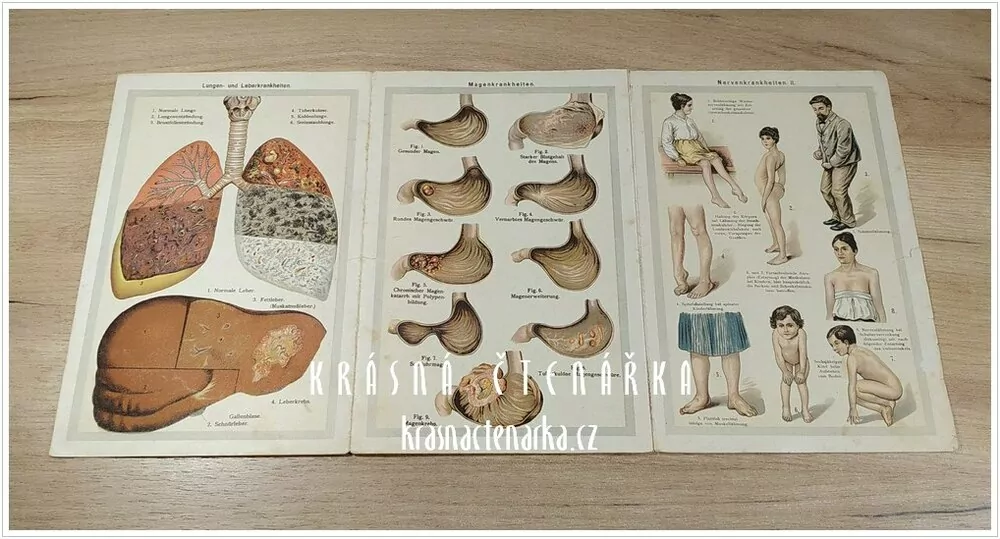 ATLAS ÄUßERER UND INNERER KRANKHEITEN des menschlichen Körpers zu Bilz, Naturheilvefahren